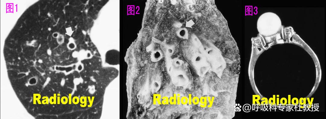 1分钟教你看懂ct报告单,一分钟自测支气管炎