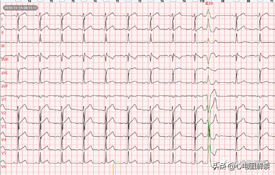 房性早搏与预激综合征,房性早搏伴阵性心动过速