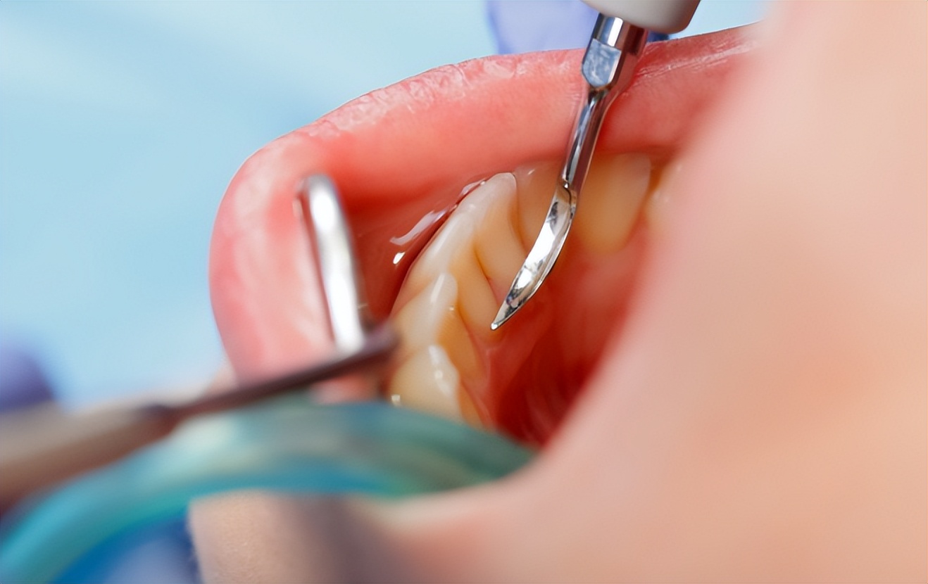 牙缝里的牙结石，如何清除干净？医生：3个办法是不少人的选择