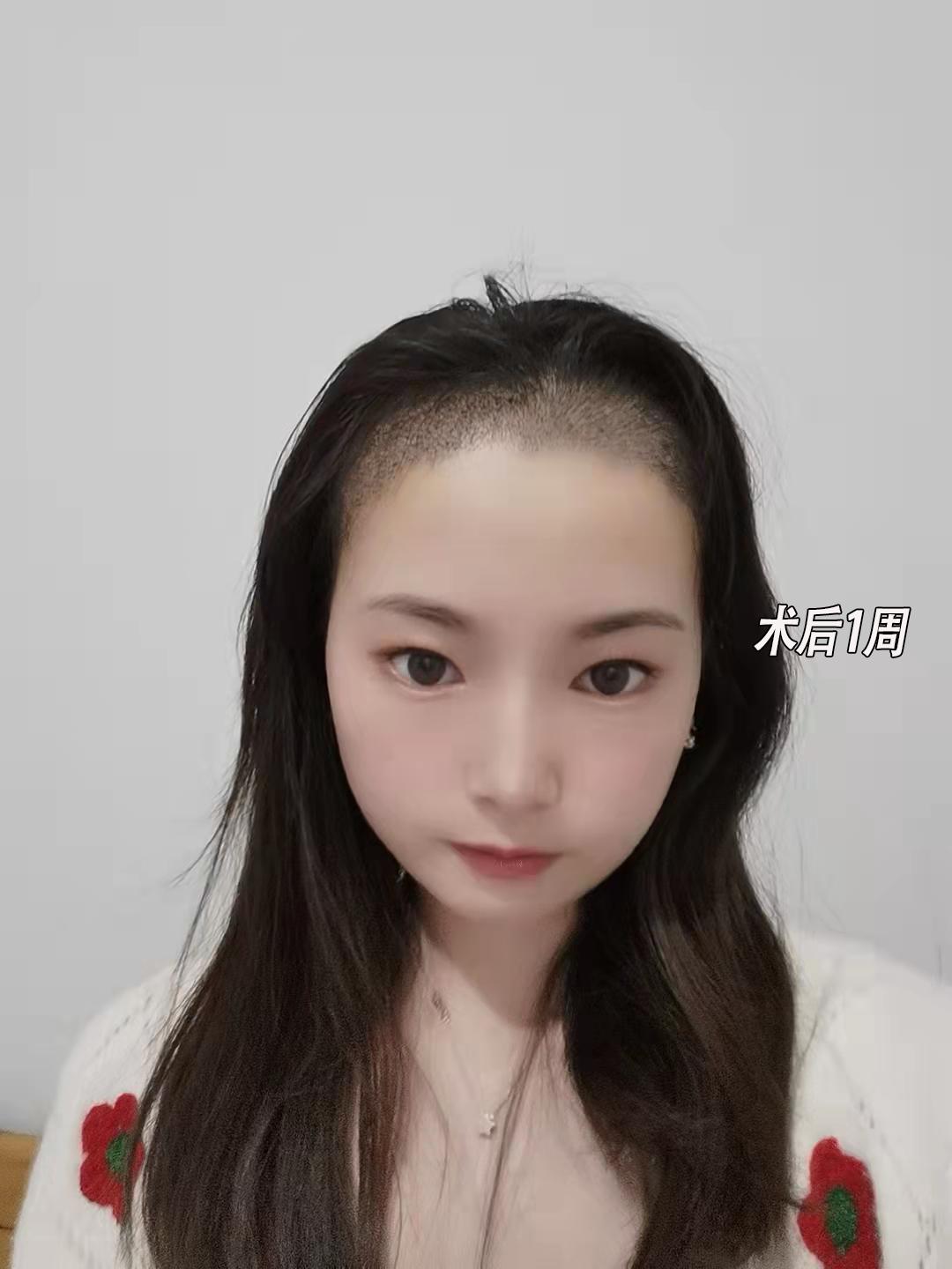 恒美植发需要多少钱,恒美植发跟碧莲盛植发