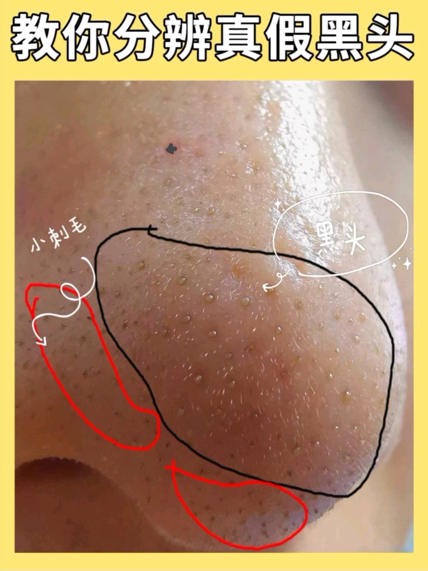 怎么去黑头好用又有效,黑头比较严重祛黑头最有效的方法