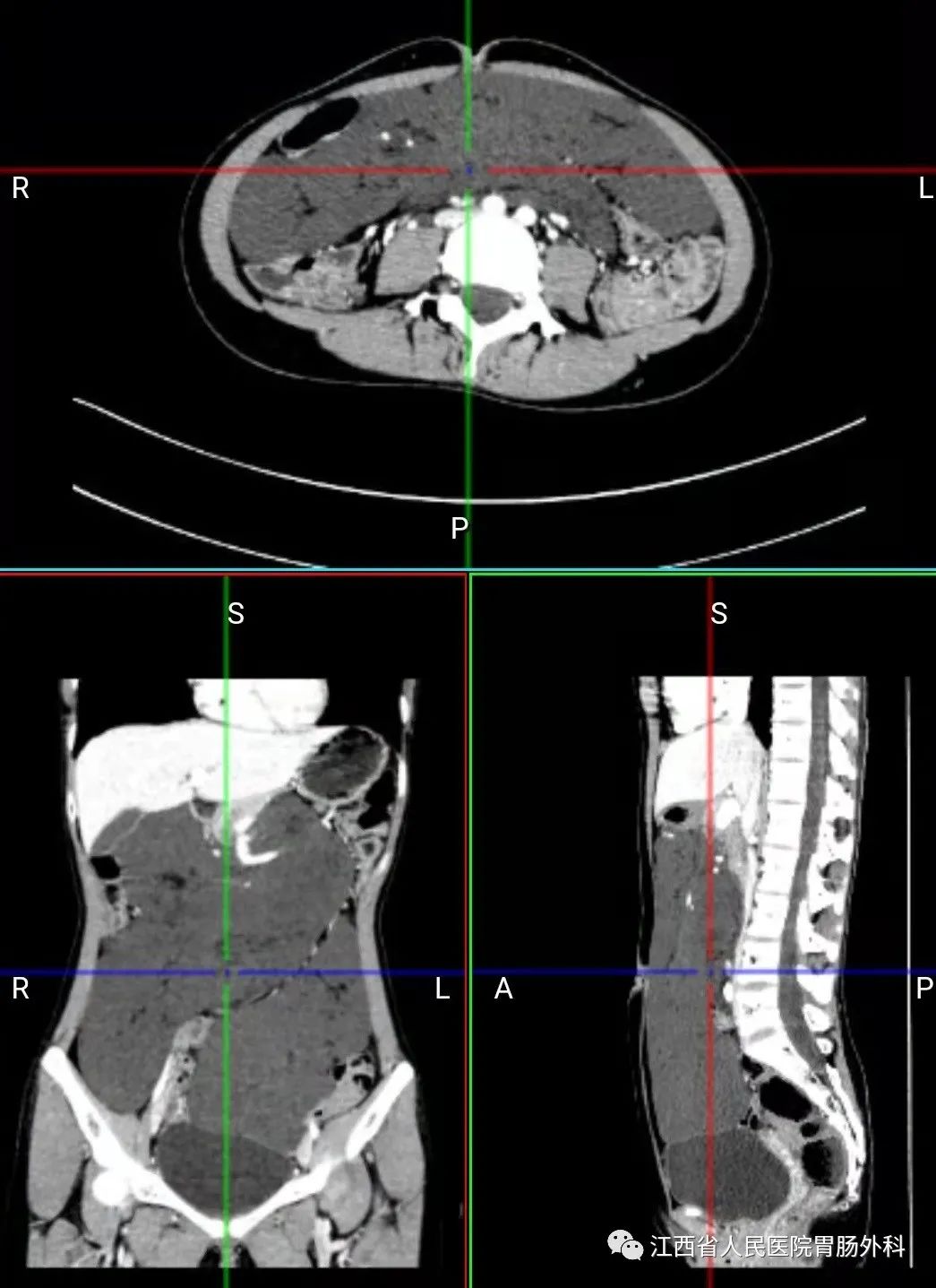 花季少女切除脏器,花季少女肚子肿瘤