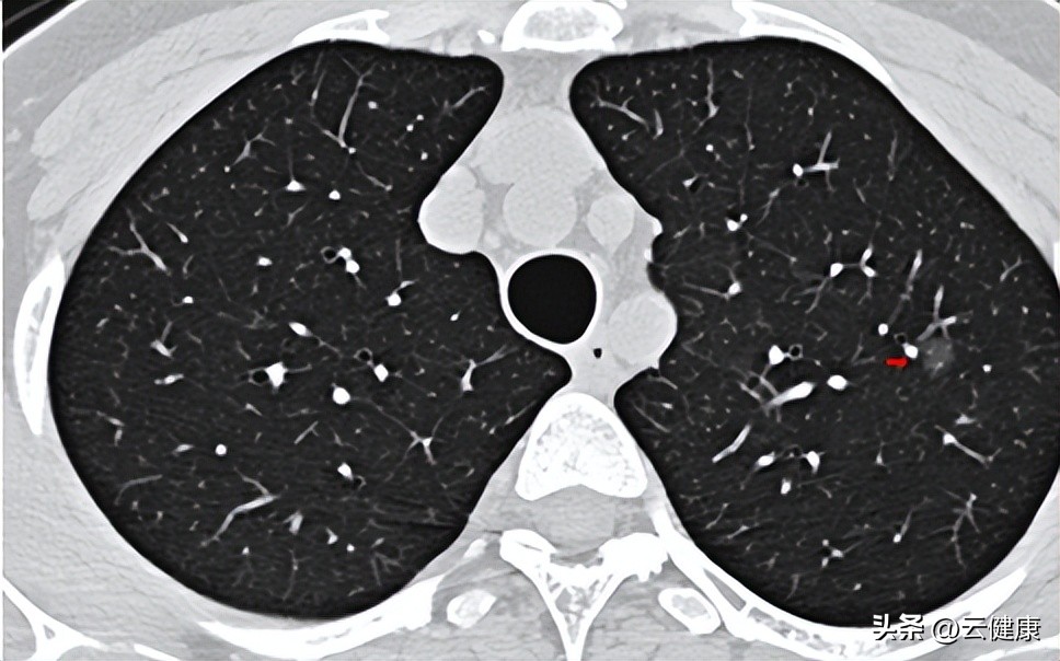 肺结节真的不能吃大虾吗,肺结节患者吃虾的好处和坏处