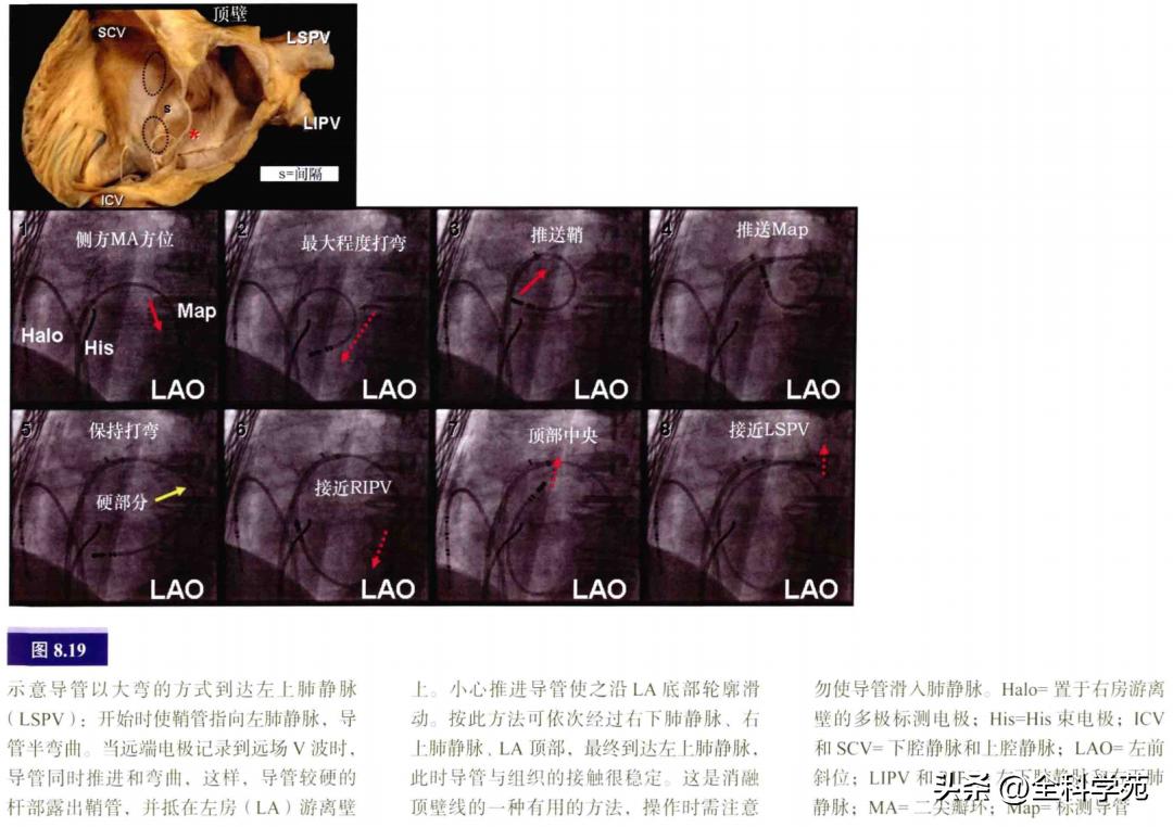 连接左心房的是肺静脉吗,左心房与肺静脉解剖