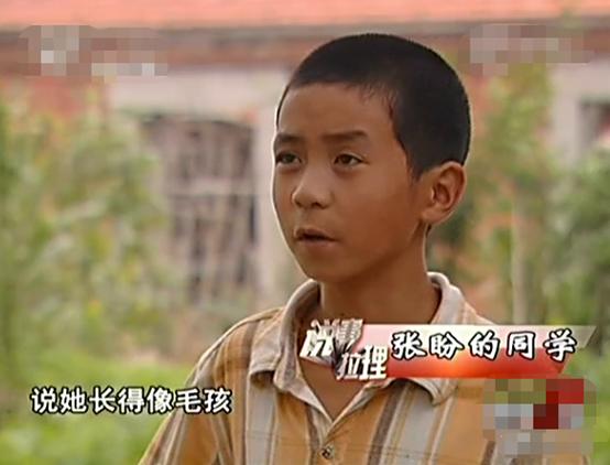 花季少女意外车祸后长胡子,14岁妙龄少女车祸后长胡子