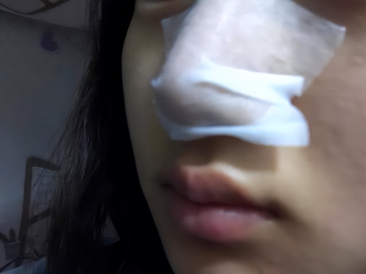 鼻头长黑粉刺怎么回事图片,鼻梁及两侧起了闭口粉刺