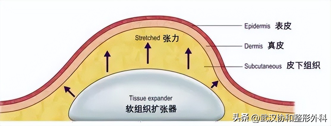扩张器到底是什么？了解一下