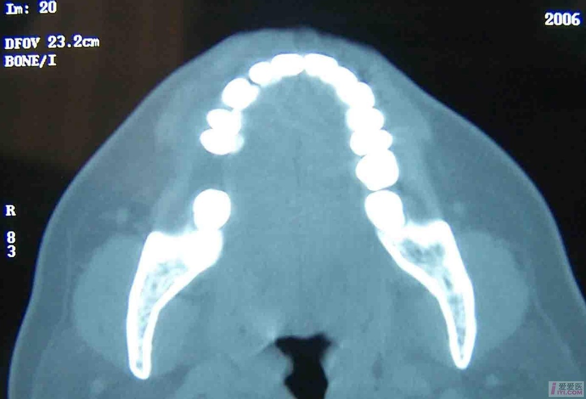 滑膜肉瘤是什么,治疗滑膜肉瘤最好的医院