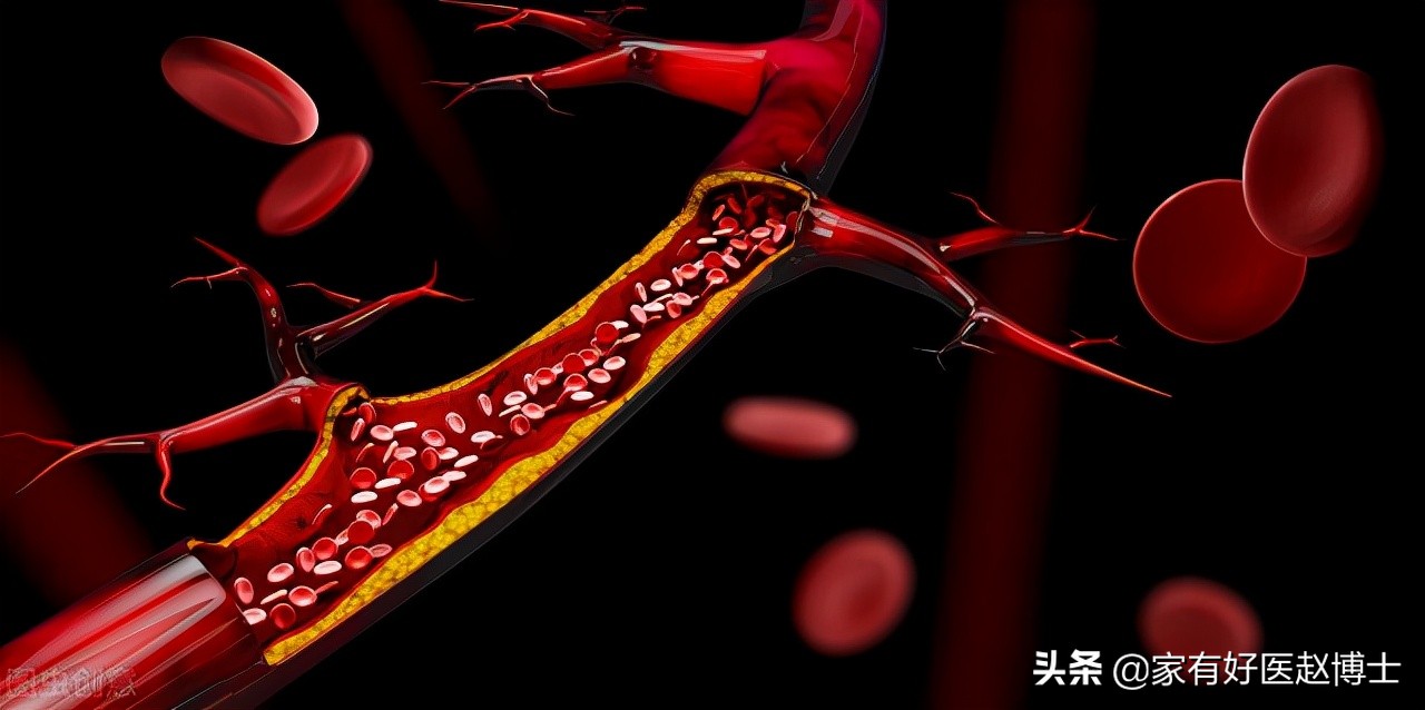 影响低密度脂蛋白胆固醇的因素,影响高胆固醇血症的因素