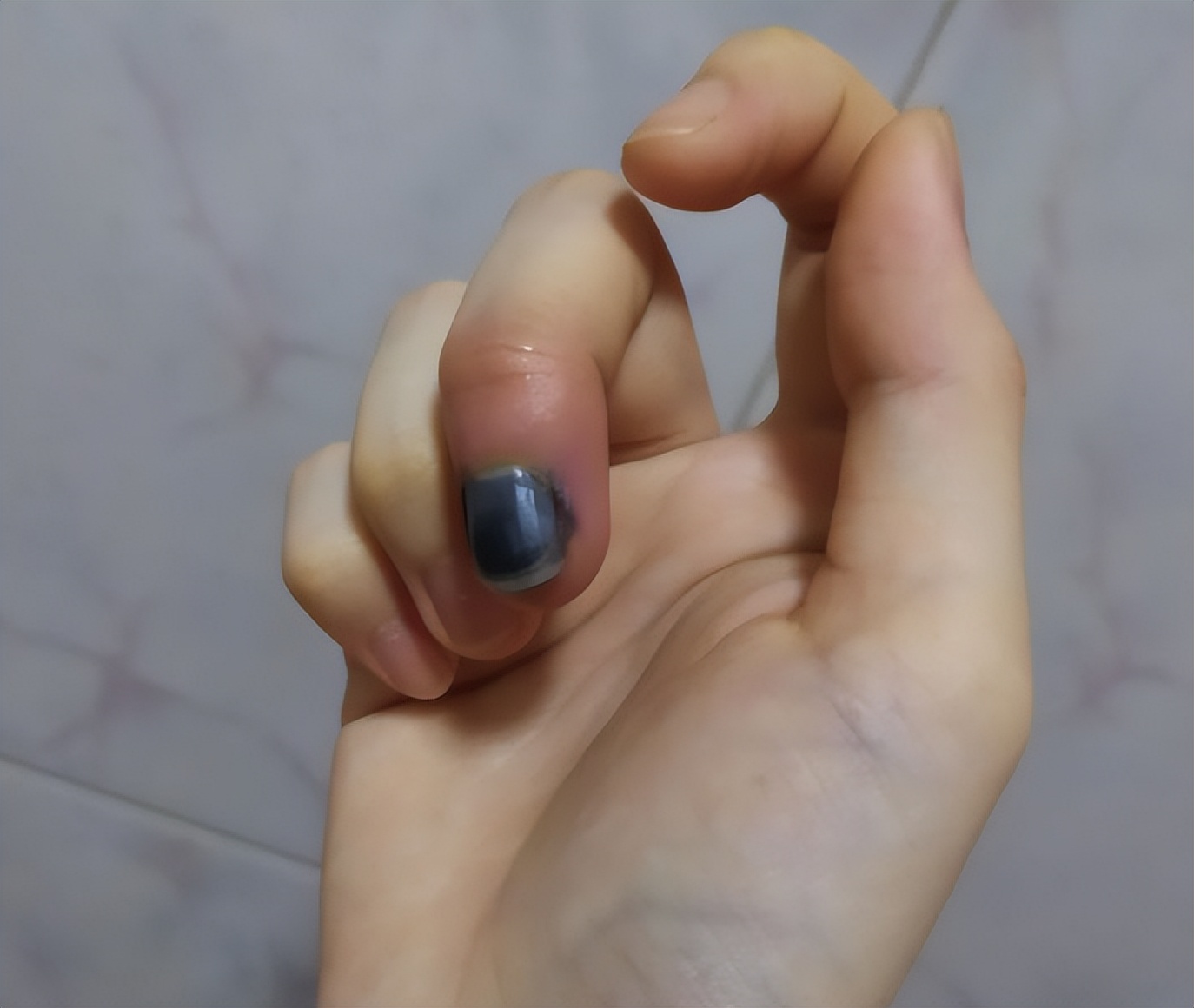 新娘新婚被夹断手指,新娘出嫁被车撞截肢