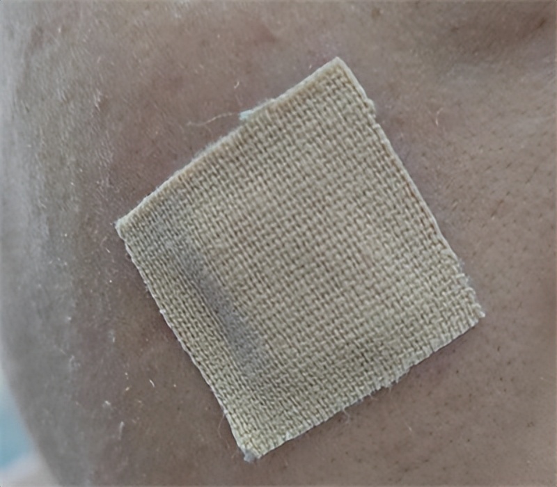 脸上的痣可以点掉吗,脸上有痣激光去痣好还是药水点好