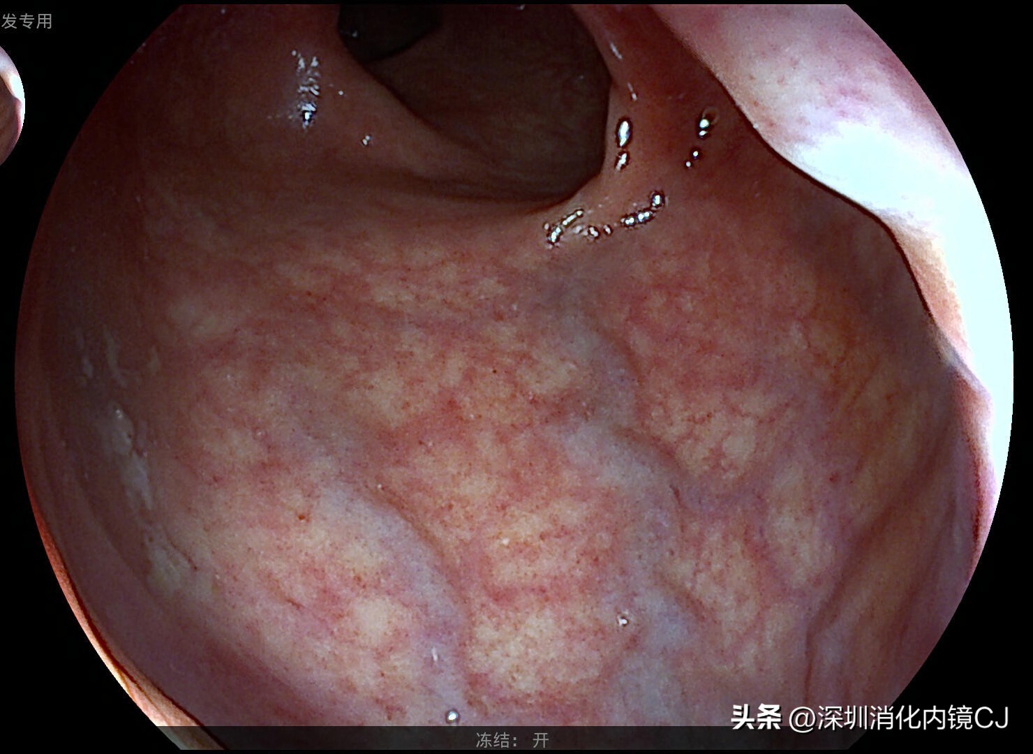 iii型痔疮,哪些痔疮患者适合内镜下套扎治疗