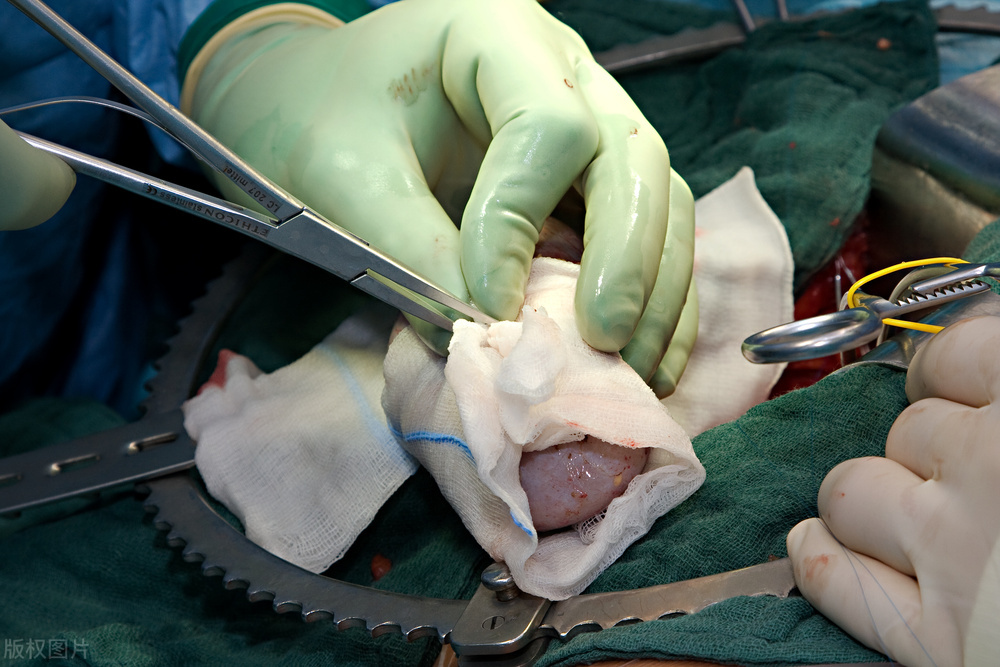 肾移植失败什么后果,肾移植失败有什么症状出现