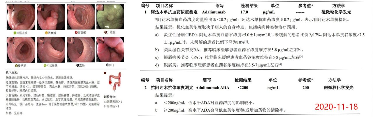 克罗恩用了乌司奴几年复发,克罗恩病阿达木单抗要打一辈子吗