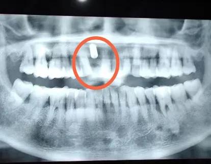 一个牙医的良心忠告种植牙,种牙戴牙冠5年后真实感受