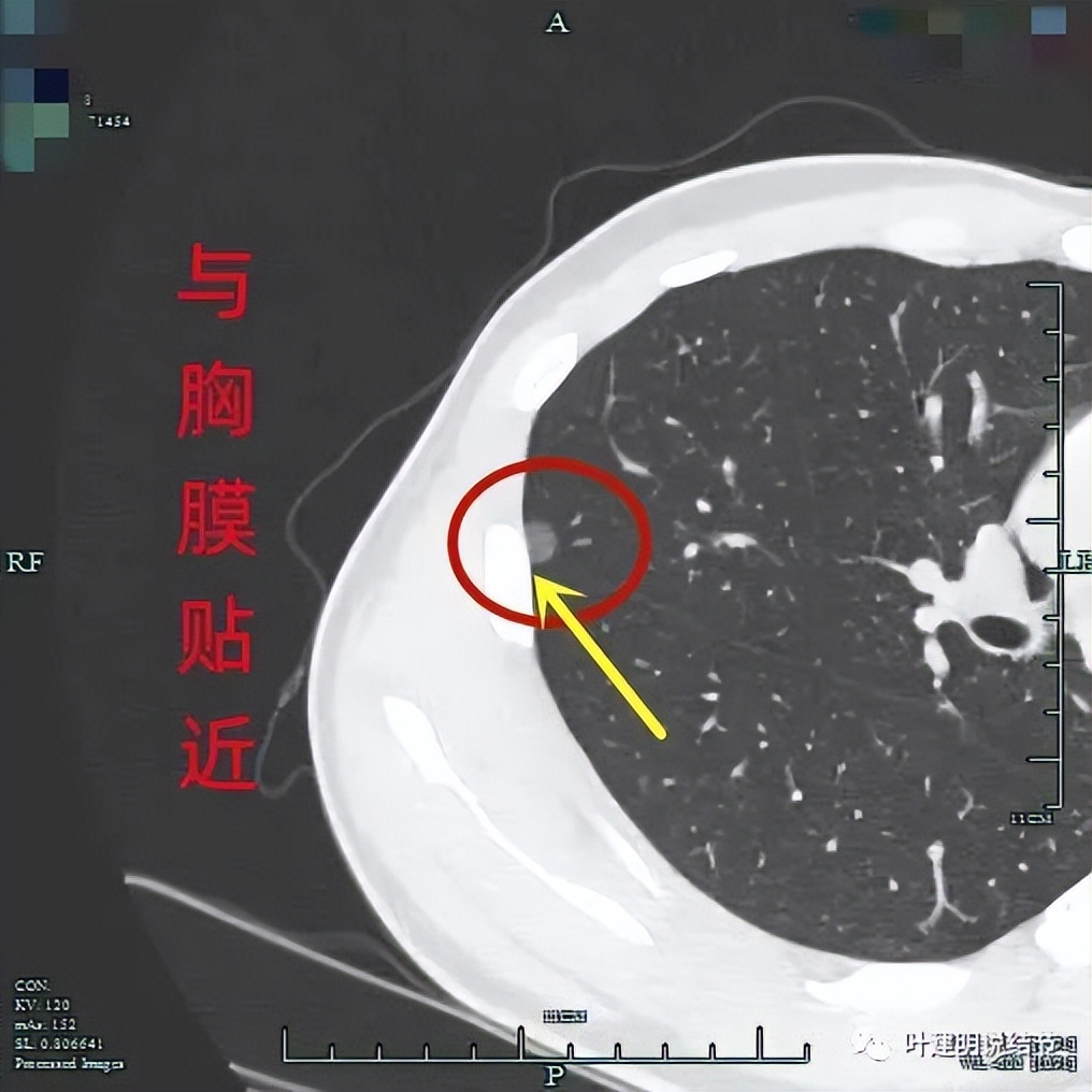 中叶多发微小结节,男性30岁右侧甲状腺单发结节