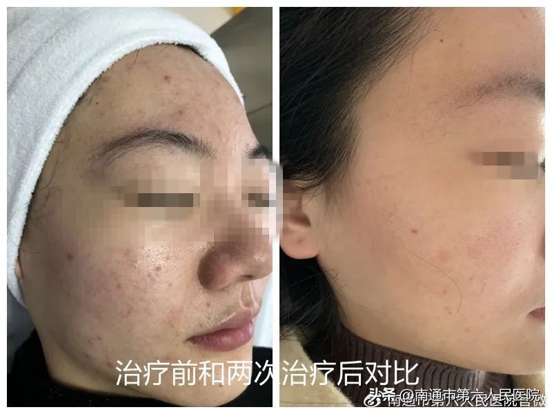 冰点脱毛除唇毛,冰点脱毛能根除体毛吗