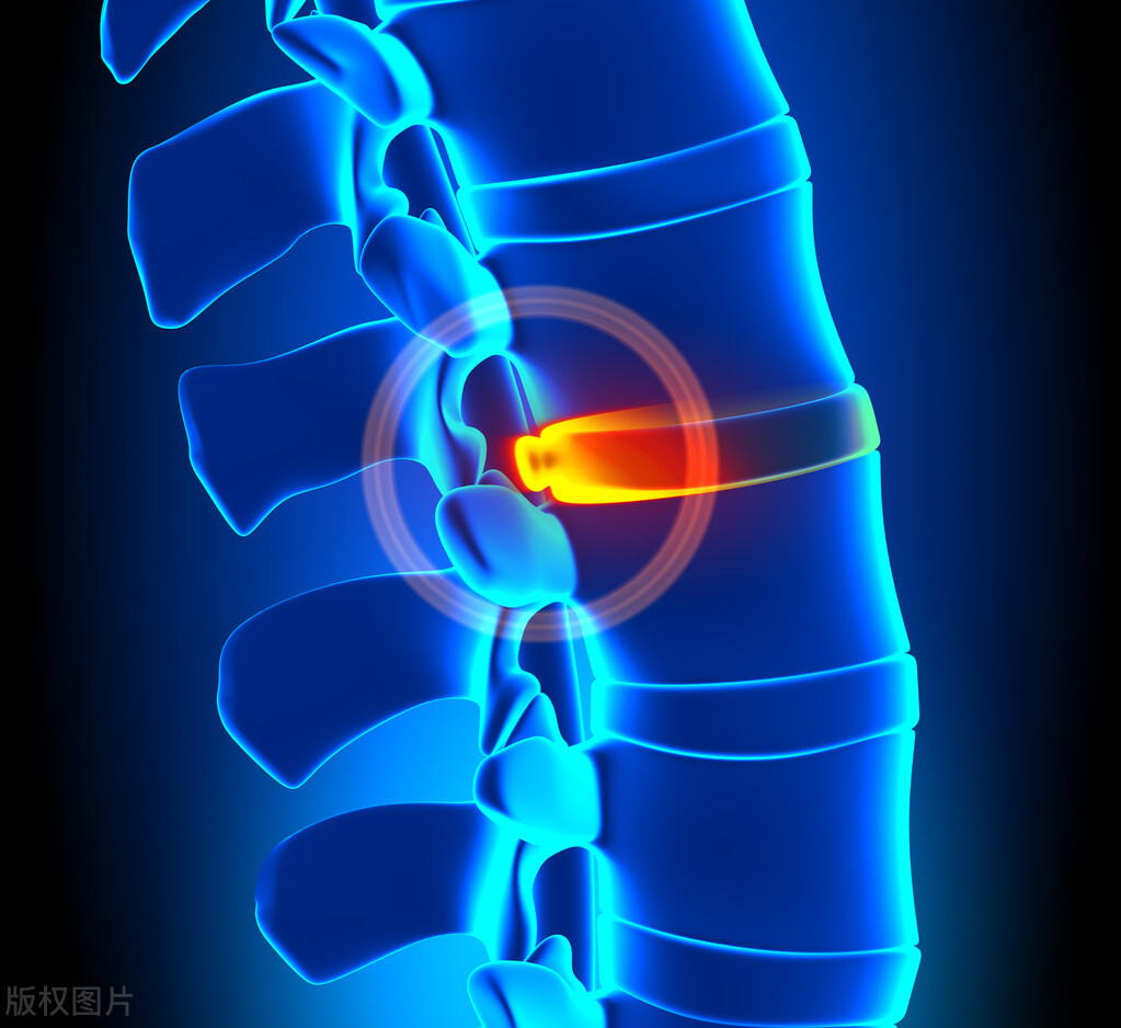 腰椎l3l4l5轻度膨出会压迫神经吗,腰椎l5s1轻度膨出适合什么锻炼