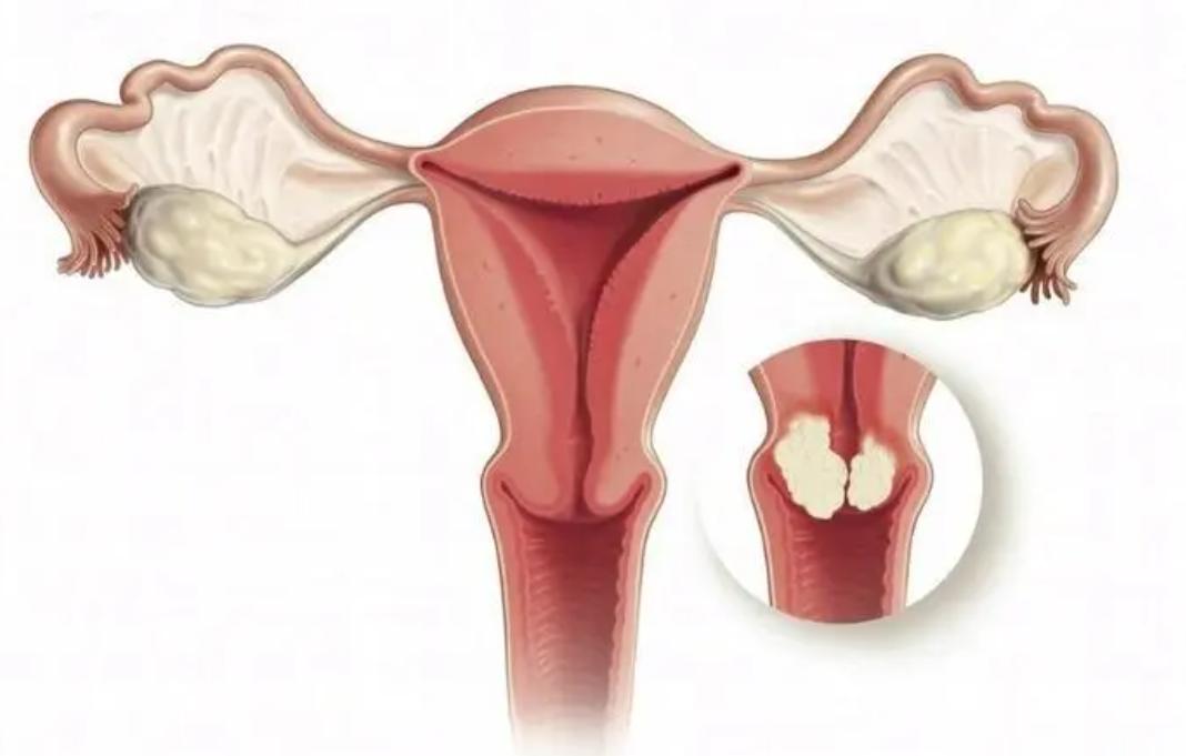 绝经后又来月经是癌变的前兆吗,绝经几年忽然又来了点月经