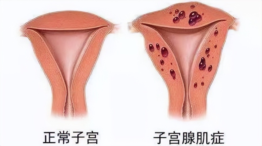 子宫腺肌症的正确治疗方法,子宫腺肌症如何治疗最新疗法
