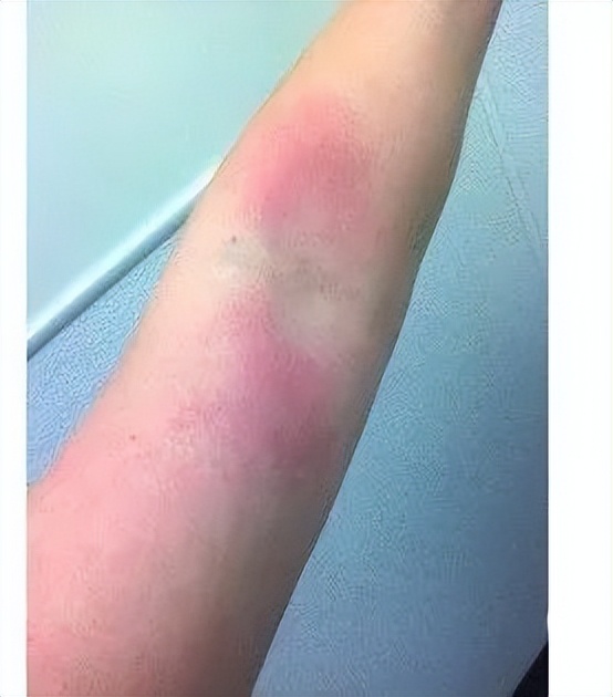 小孩子荨麻疹痒怎么止痒,小孩麻疹痒在家怎么止痒