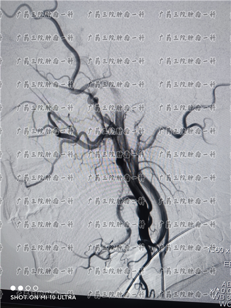 左眼肿是鼻咽癌复发吗,广药三院肿瘤专家彭齐荣