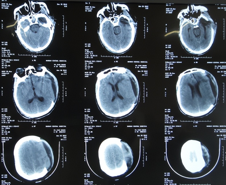 脑外伤开颅手术后继发癫痫,开颅术后颅内感染