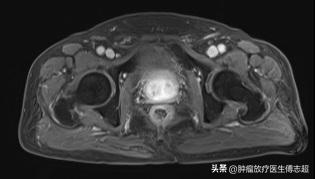 病例十：前列腺癌内分泌治疗进展后根治性放射治疗