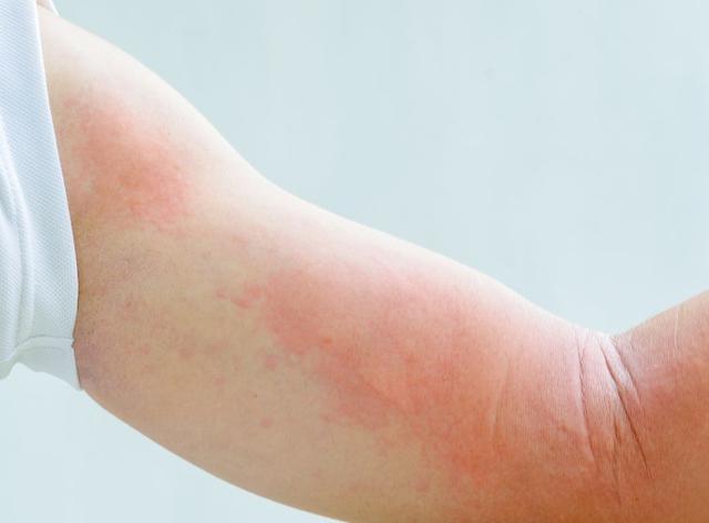 艾滋病出现的皮肤病不治会自愈吗,艾滋病潜伏期会单纯出现皮肤病吗