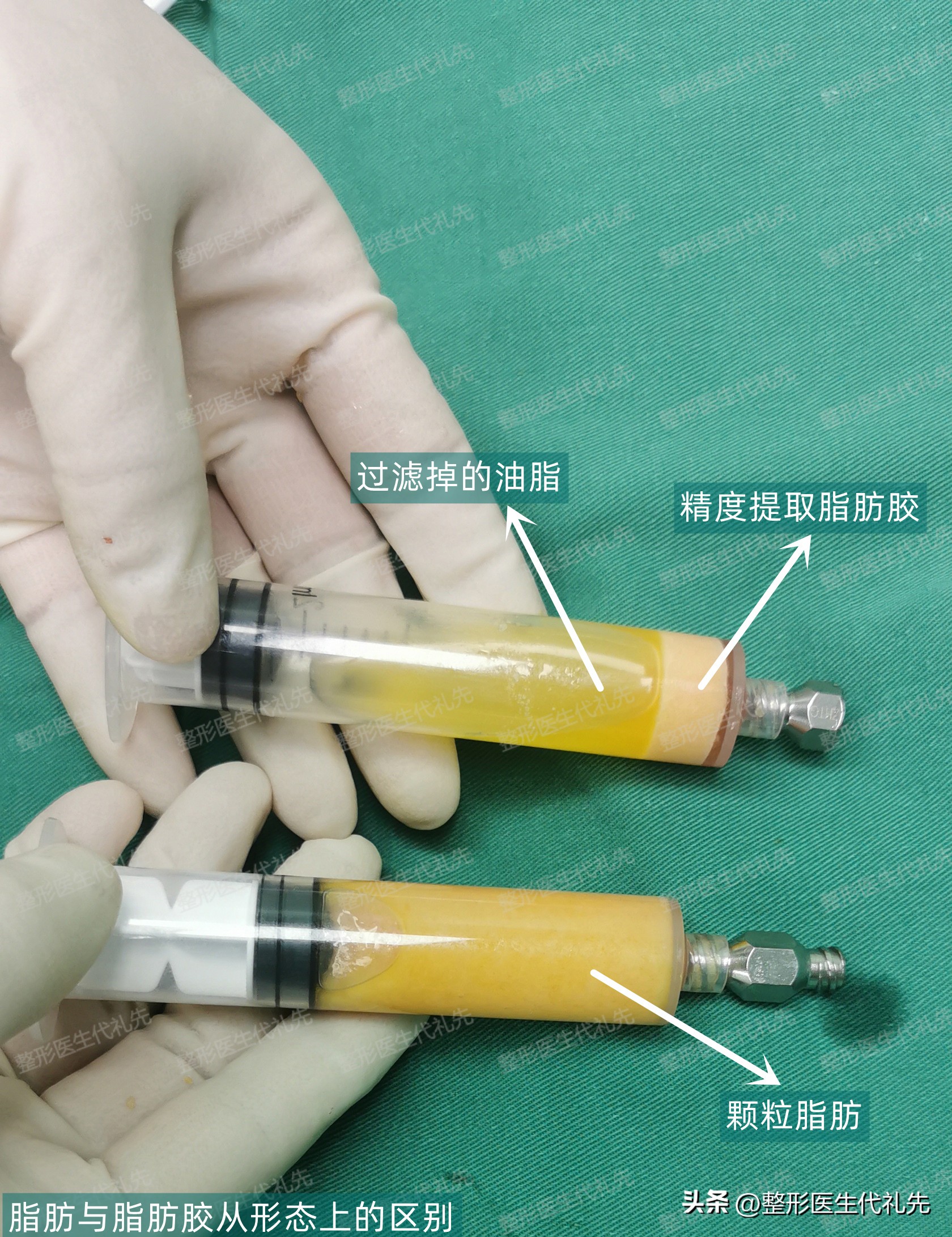 面部脂肪填充一般要多少脂肪量,脂肪填充面部有哪些脂肪可以做