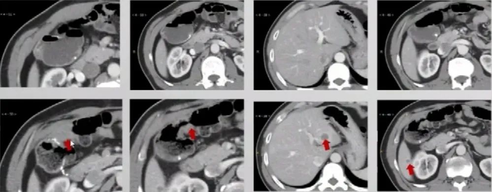 多原发癌症转移,多原发直肠癌