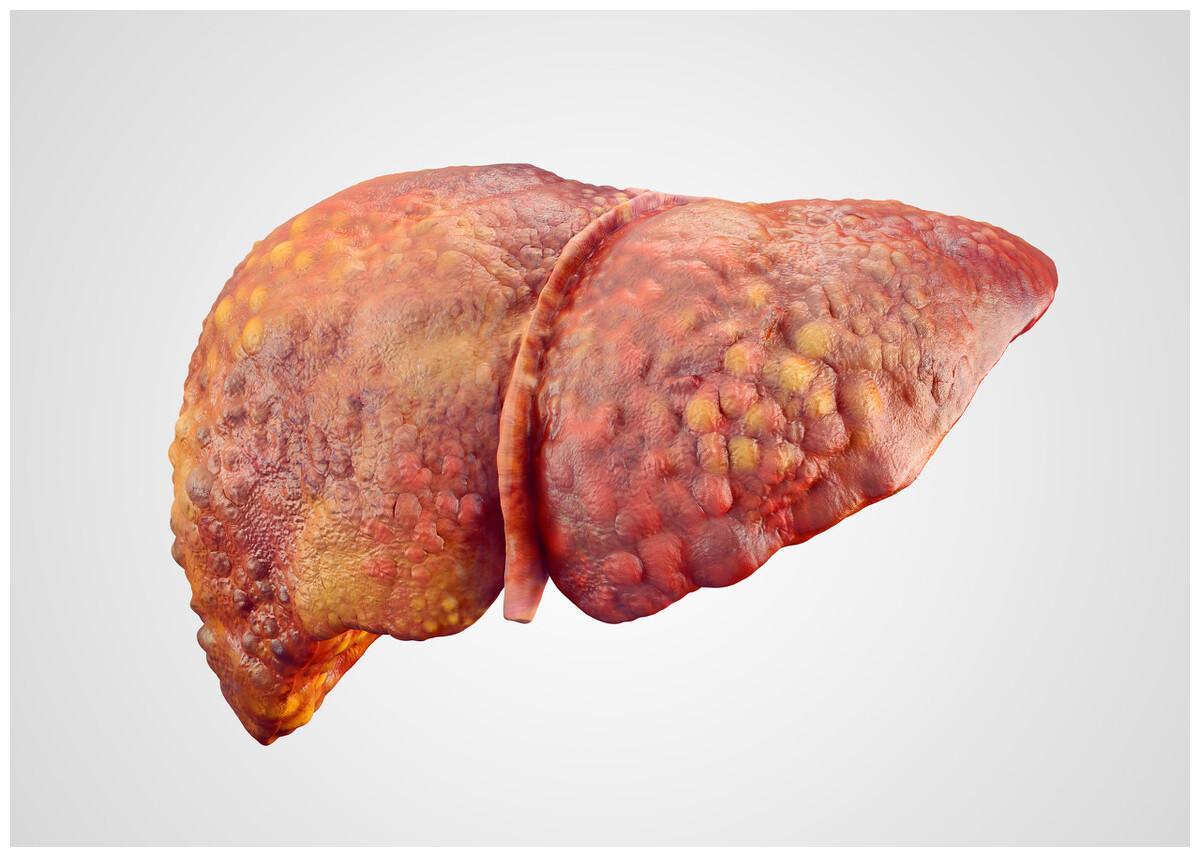 八十岁老人肝癌可以手术风险大吗,肝癌扩散怎么治疗治疗方案是什么