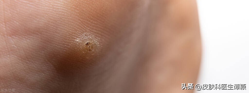 皮肤科医生讲疣,皮肤科病毒疣