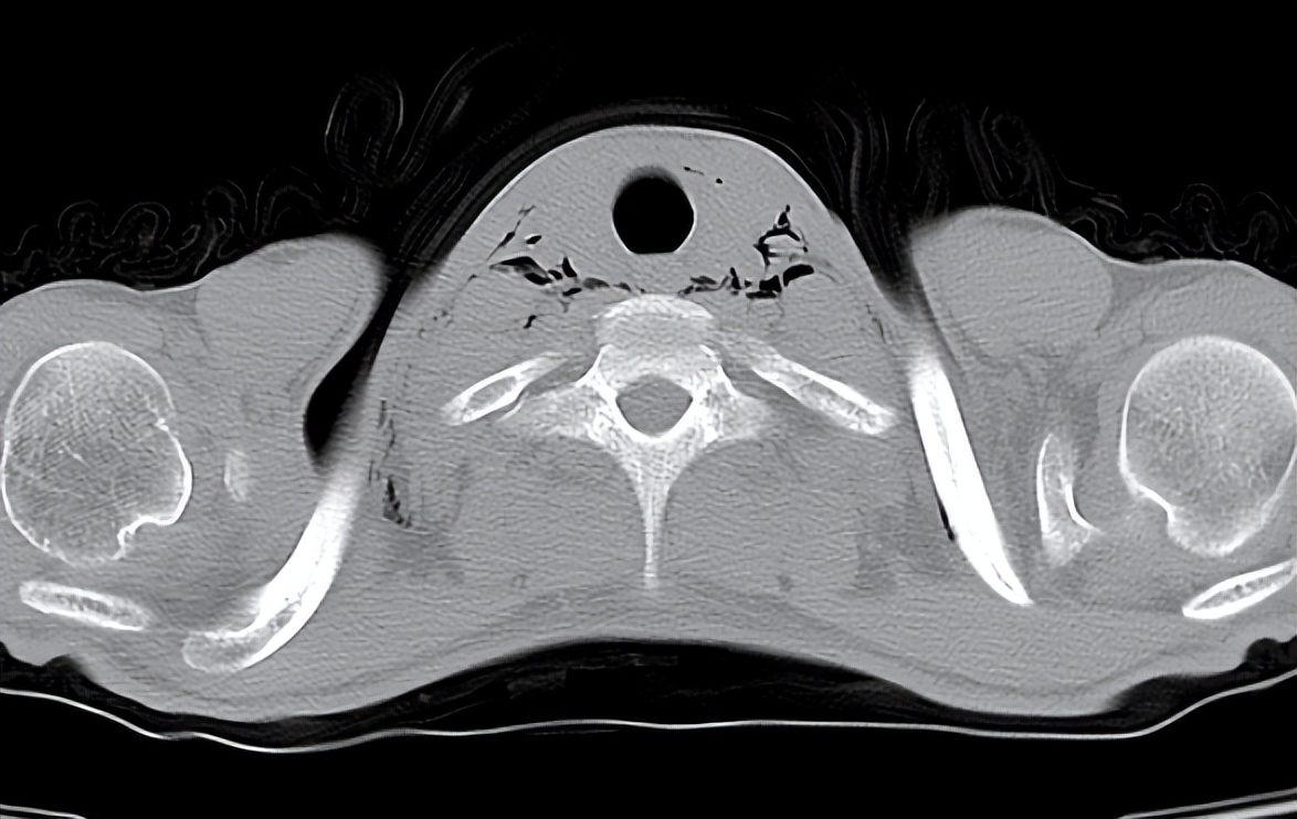 关注|纵隔，你“肿”么了？