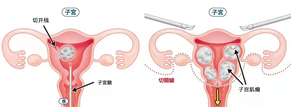 血崩到底是什么,血崩什么感觉