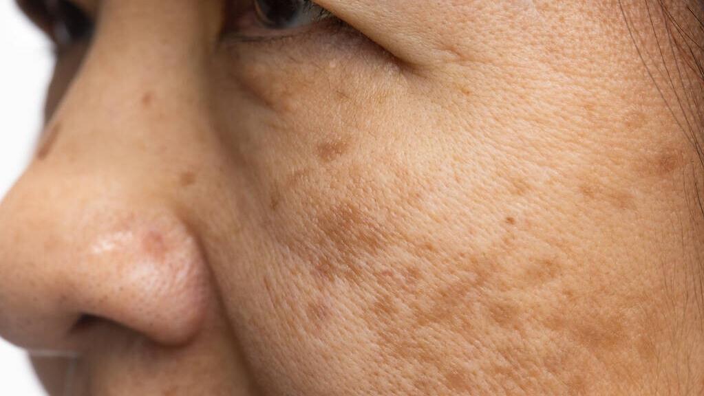 几块钱的“红霉素”软膏,竟是*褐斑黄**的“克星”?医生告诉你真相