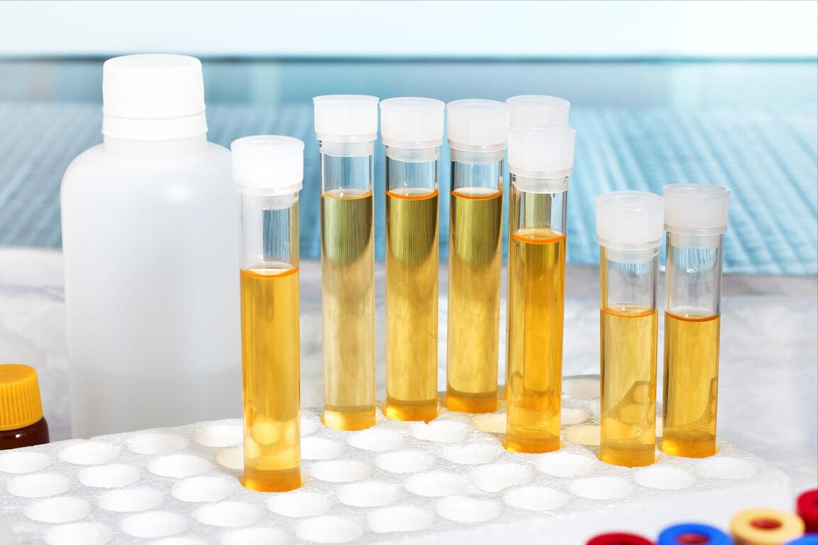 反复血尿是结石引起的吗,反复尿血是肾炎吗怎么治疗