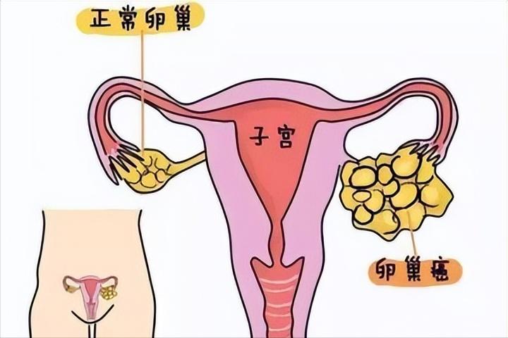 女子长期腿痛查出宫颈癌,女子患宫颈癌