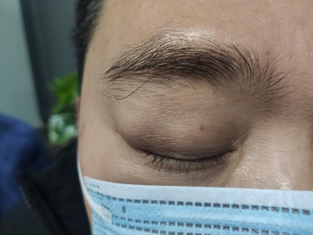 眼皮上长了个疙瘩说是肿瘤,眼皮里长了个小瘤不痛