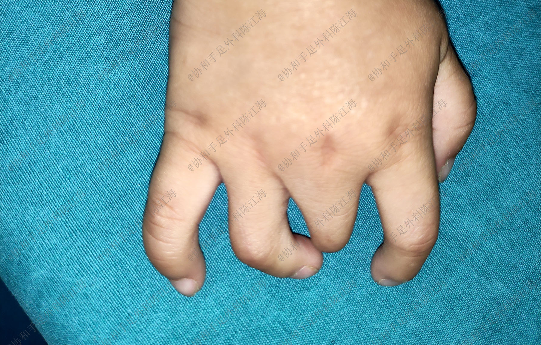 6个月宝宝手短,六个月宝宝手指肿胀怎么回事