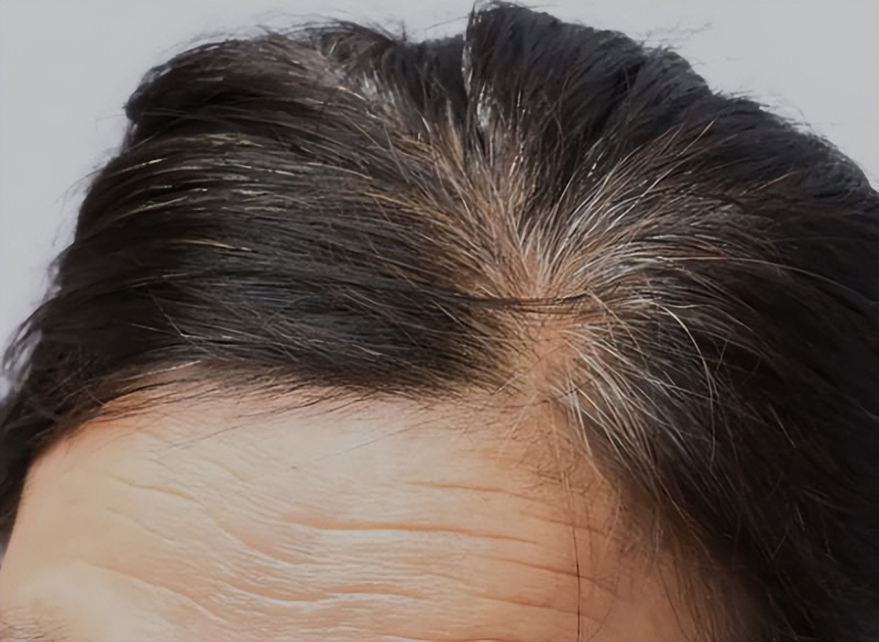 年轻白头发是缺少什么营养,年轻人白头发是一般营养不足吗