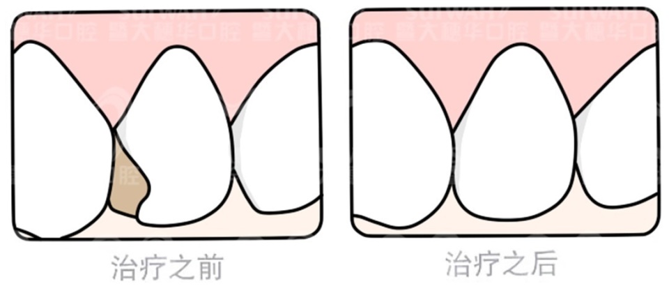 暨大穗华口腔种植一颗牙多少钱,暨大穗华口腔1980种牙靠谱吗