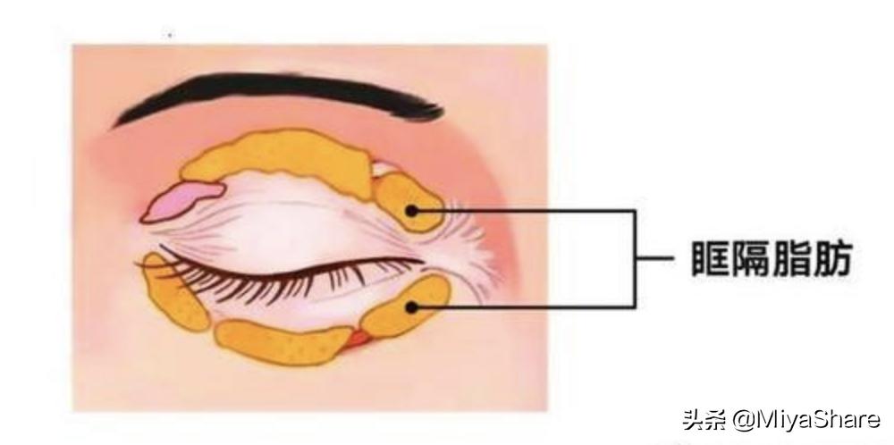 拖了一年的手术,眼袋手术5年后的感受