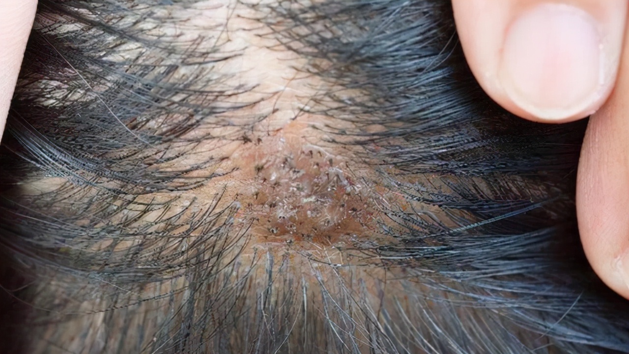 天天洗头有头皮屑怎么办,天天洗头也有头皮屑是什么原因