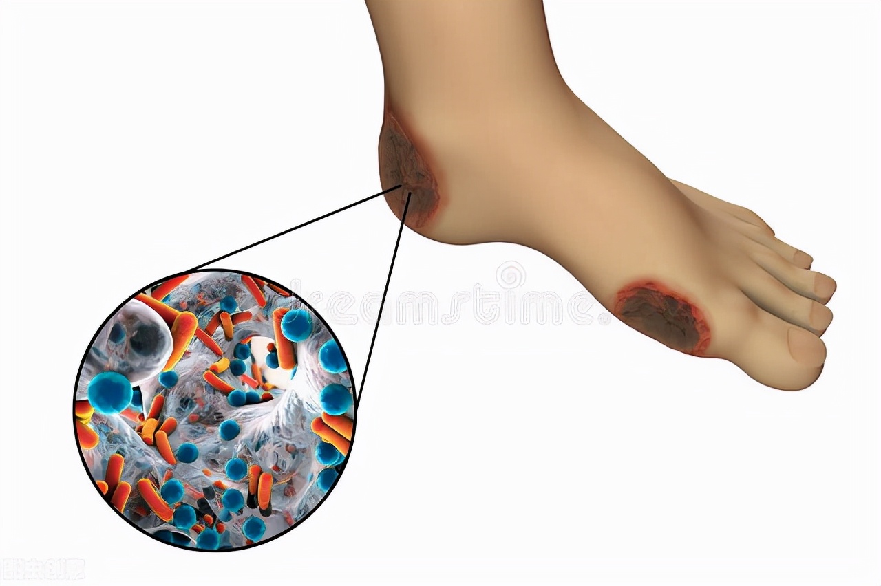 得了糖尿病不忌口怎么样,得了糖尿病不控制饮食会怎样