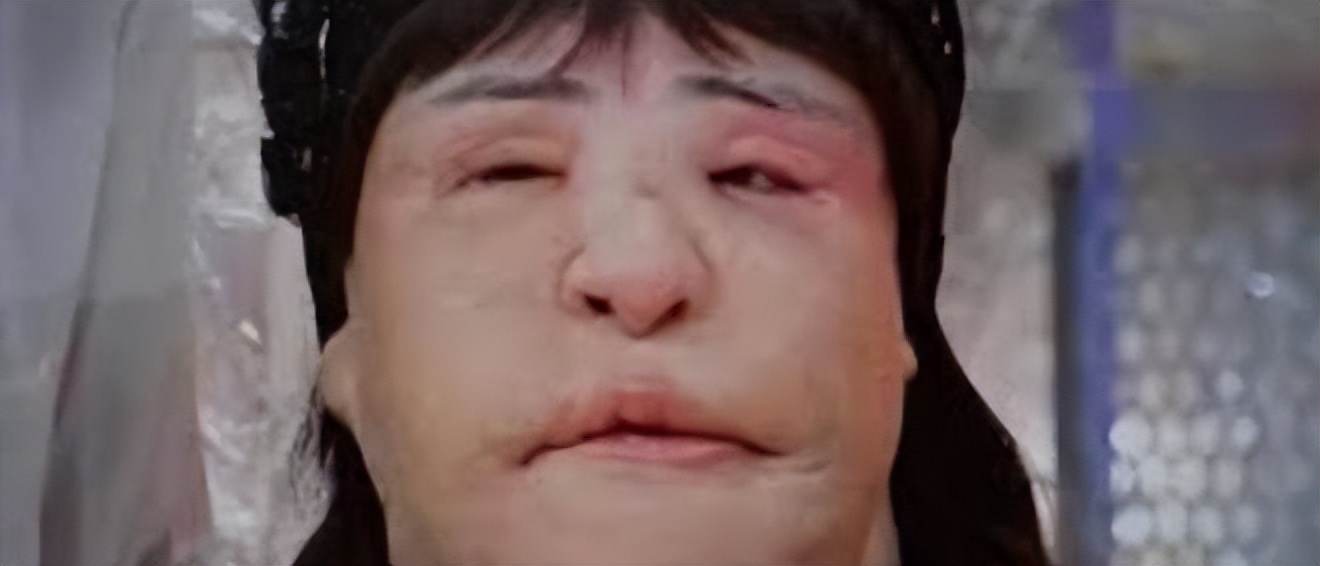 韩慧景整容是打了玻尿酸了吗,韩慧景整容案例