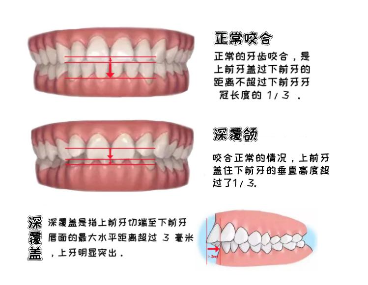深覆颌深覆盖什么情况下不用矫正,深覆盖和深覆颌哪个严重些