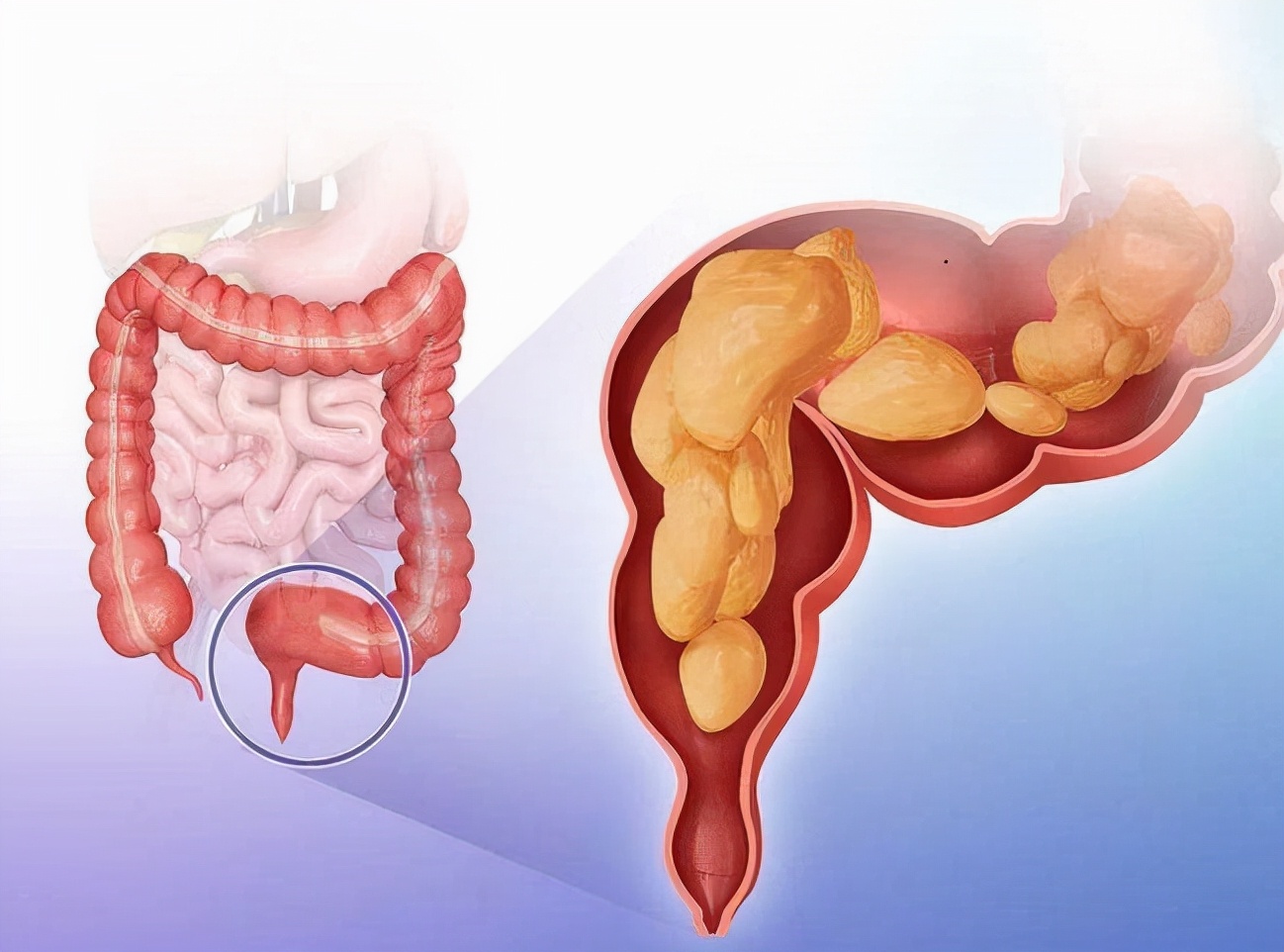 直肠癌新辅助疗法放疗效果,直肠癌新辅助化疗法