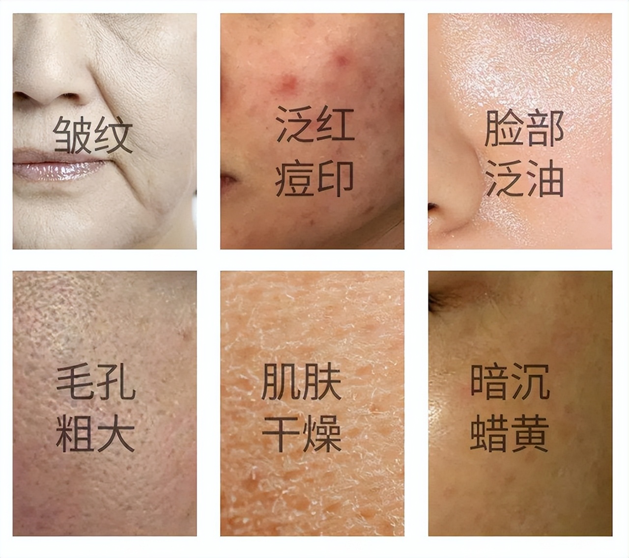 皮肤糖化怎么改善,皮肤糖化怎么治