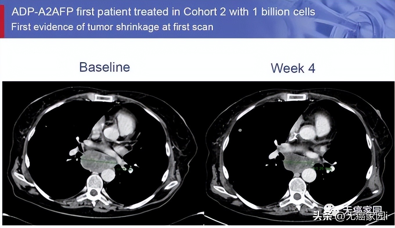 CAR-T疗法全球首例,car-t疗法和nk疗法